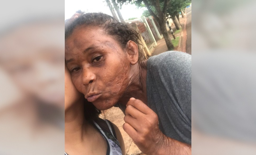 Mulher atacada por pitbulls morre após ficar quatro dias internada