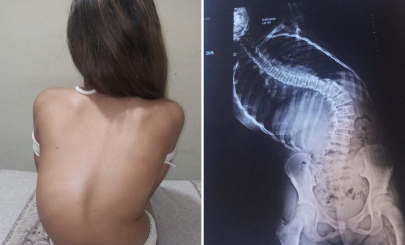 Ana Patrícia Maestrello, de 35 anos, contou ao g1 que a filha, Agatha Rebeca Maestrello, de 12 anos, foi diagnosticada com Escoliose Idiopática — Foto: Ana Patrícia Maestrello /Arquivo Pessoal